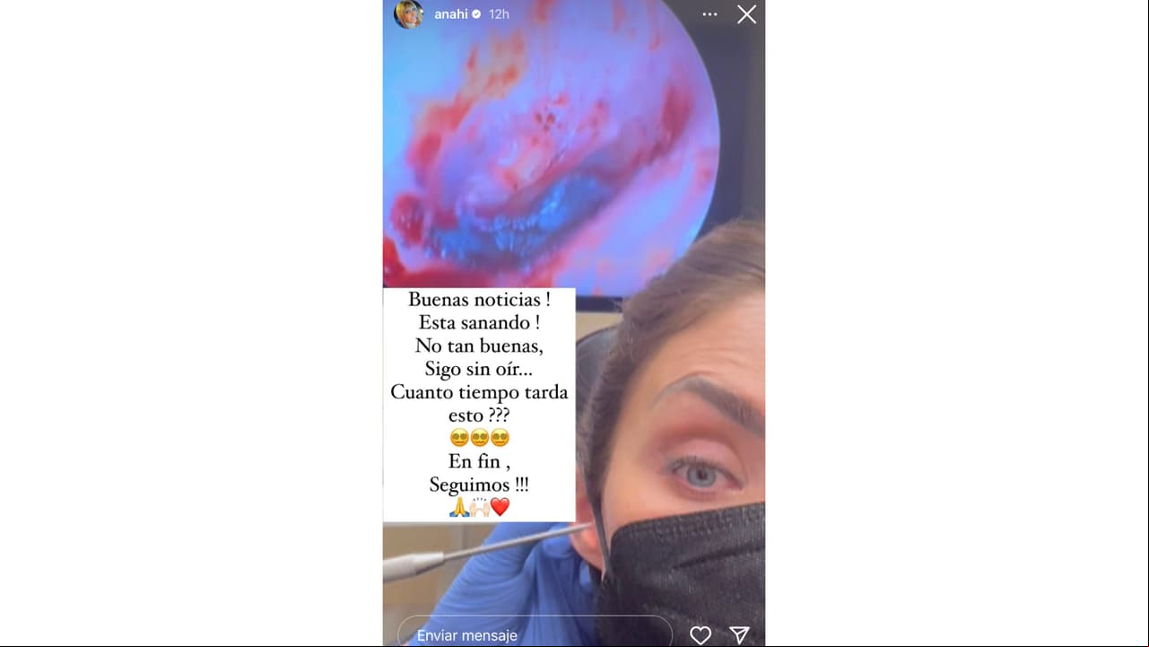 Anahí revela cómo está su oído luego de que le perforaron el tímpano.