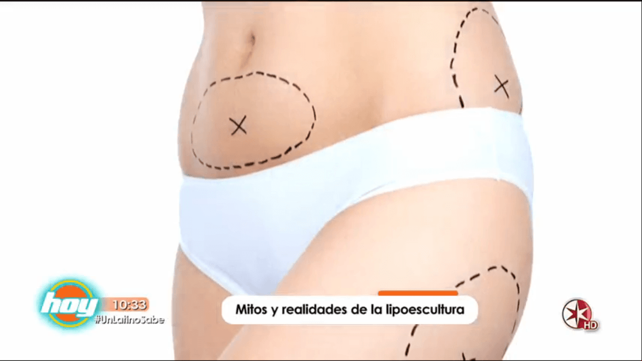 Mitos y realidades de la lipoescultura